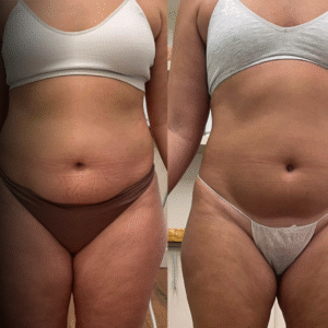 Copia de LIPO LASER (1)