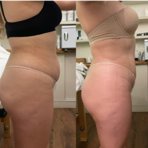 Copia de LIPO LASER (2)